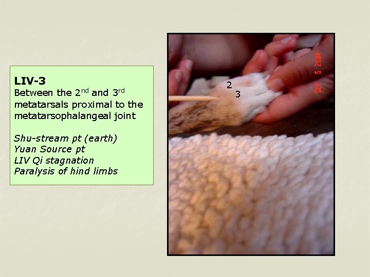 LIV-3 Between the 2 nd and 3 rd metatarsals proximal to the metatarsophalangeal joint