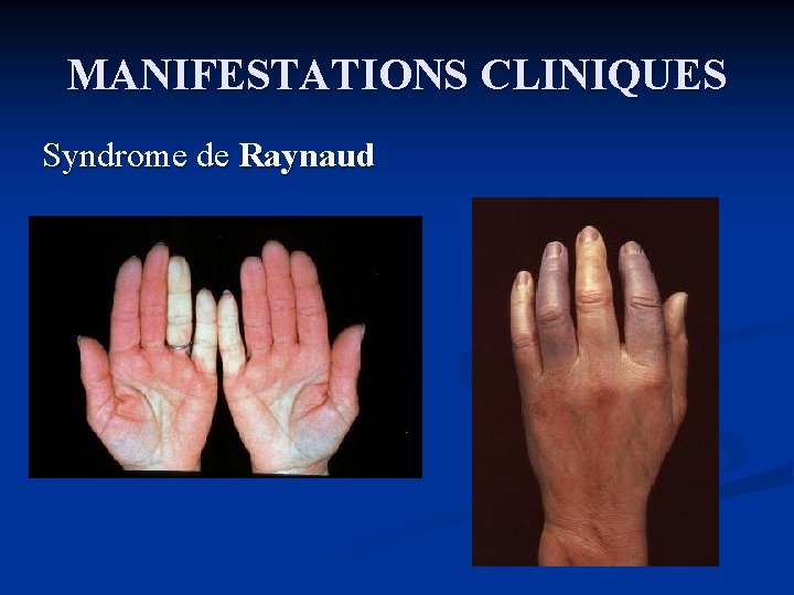 MANIFESTATIONS CLINIQUES Syndrome de Raynaud 