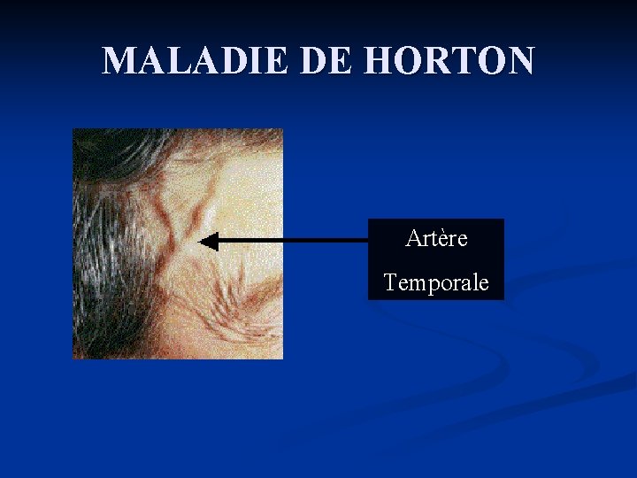 MALADIE DE HORTON Artère Temporale 