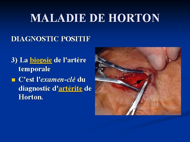 MALADIE DE HORTON DIAGNOSTIC POSITIF 3) La biopsie de l'artère temporale n C'est l'examen-clé