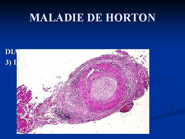 MALADIE DE HORTON DIAGNOSTIC POSITIF 3) La biopsie de l'artère temporale 
