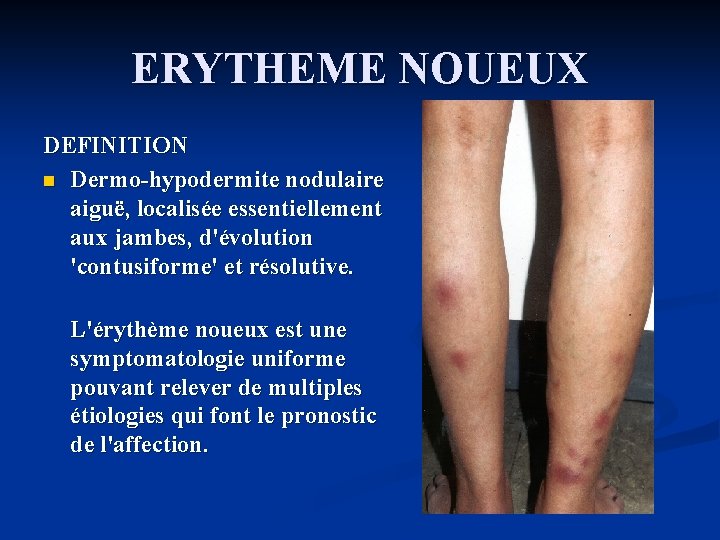 ERYTHEME NOUEUX DEFINITION n Dermo-hypodermite nodulaire aiguë, localisée essentiellement aux jambes, d'évolution 'contusiforme' et