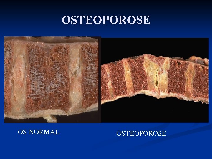 OSTEOPOROSE OS NORMAL OSTEOPOROSE 