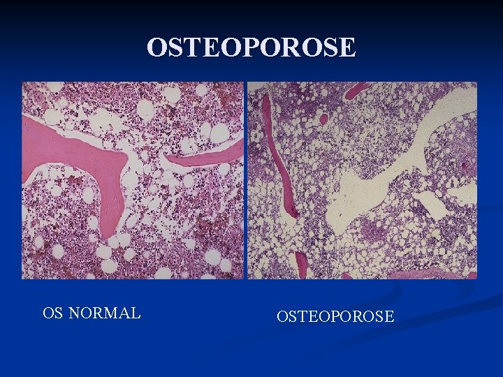 OSTEOPOROSE OS NORMAL OSTEOPOROSE 