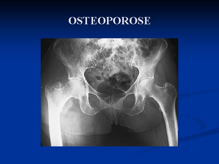 OSTEOPOROSE 