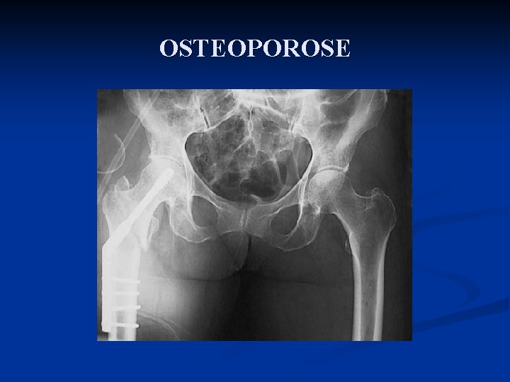 OSTEOPOROSE 