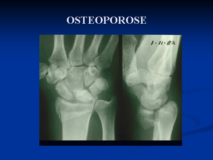 OSTEOPOROSE 