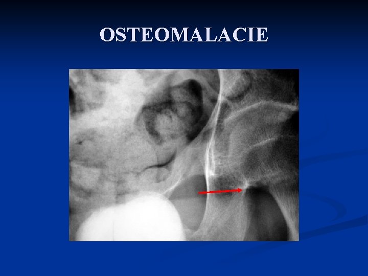 OSTEOMALACIE 