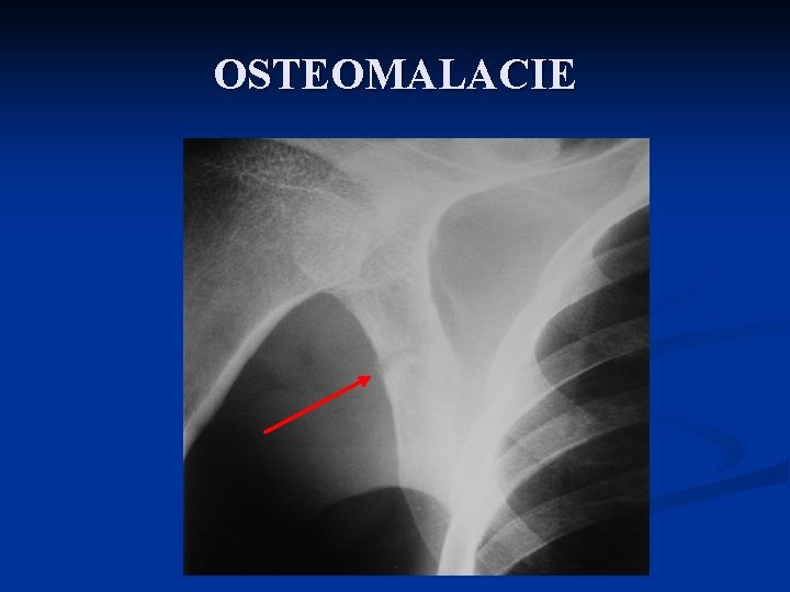 OSTEOMALACIE 