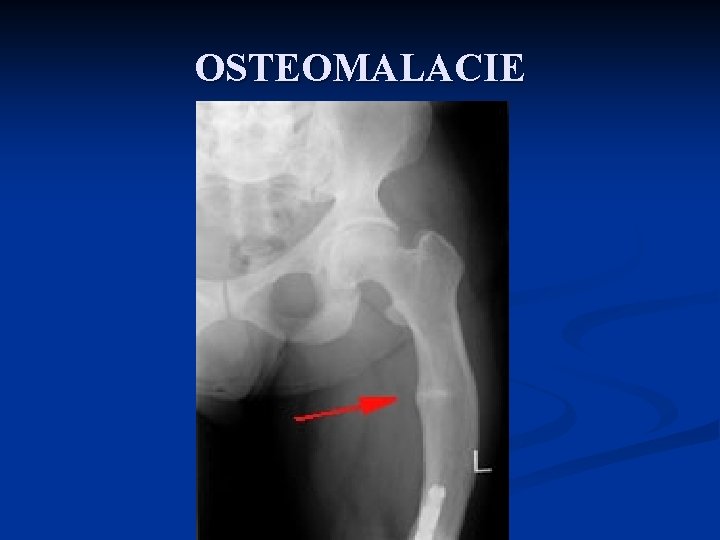 OSTEOMALACIE 