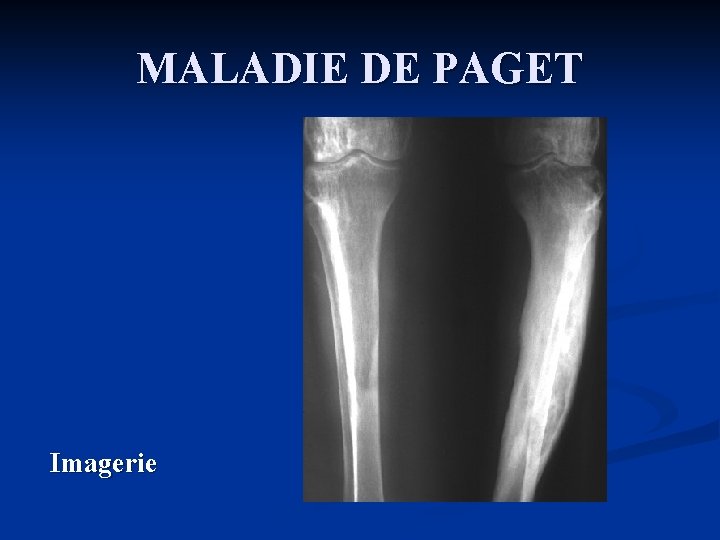 MALADIE DE PAGET Imagerie 