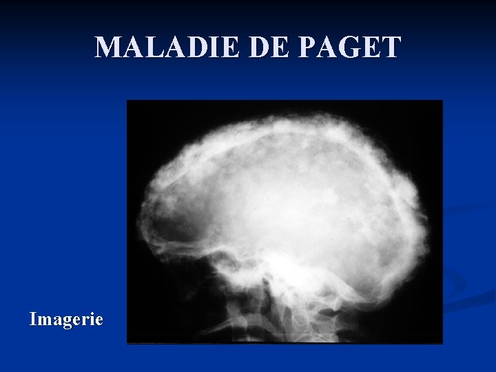 MALADIE DE PAGET Imagerie 