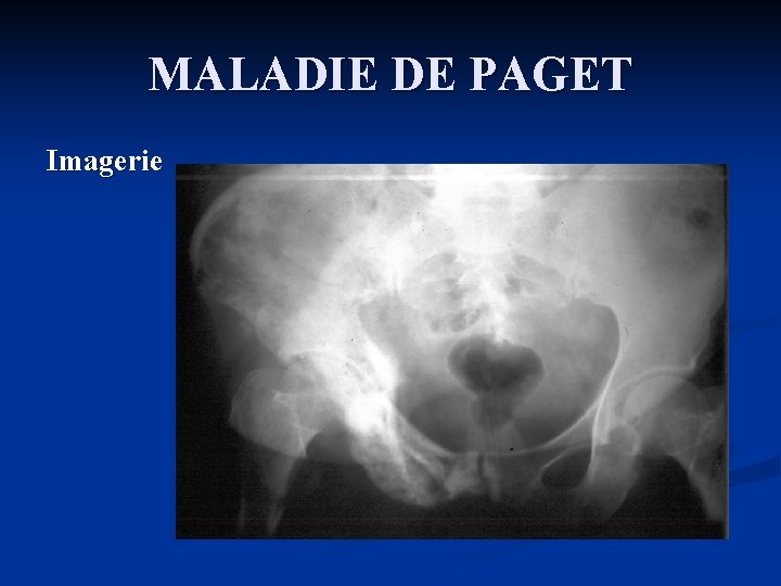 MALADIE DE PAGET Imagerie 