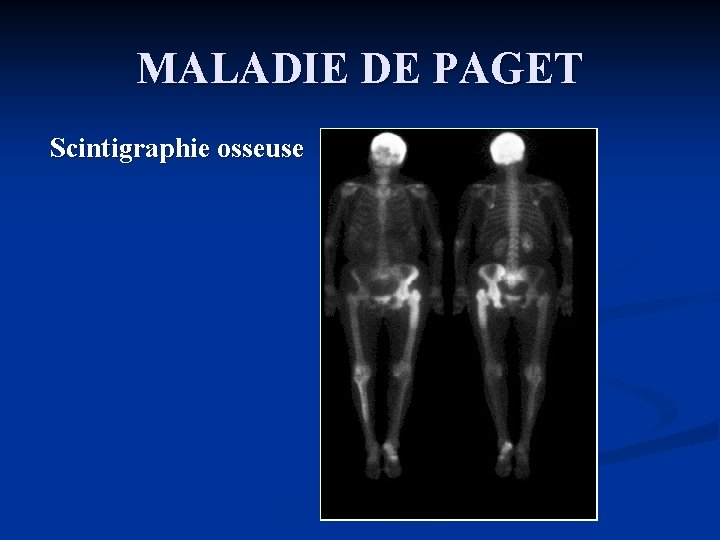 MALADIE DE PAGET Scintigraphie osseuse 