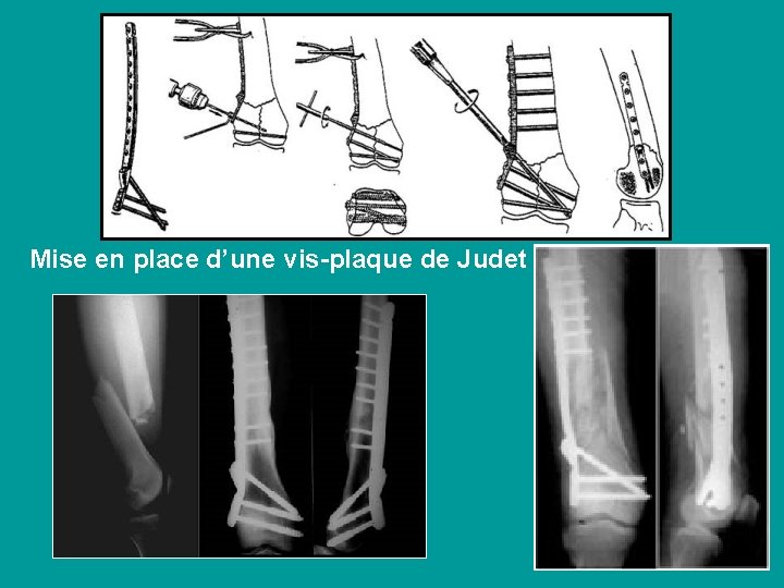 Mise en place d’une vis-plaque de Judet 