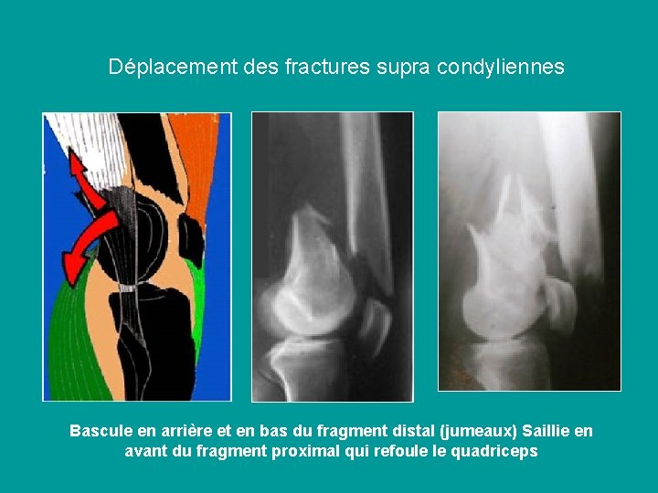 Déplacement des fractures supra condyliennes Bascule en arrière et en bas du fragment distal
