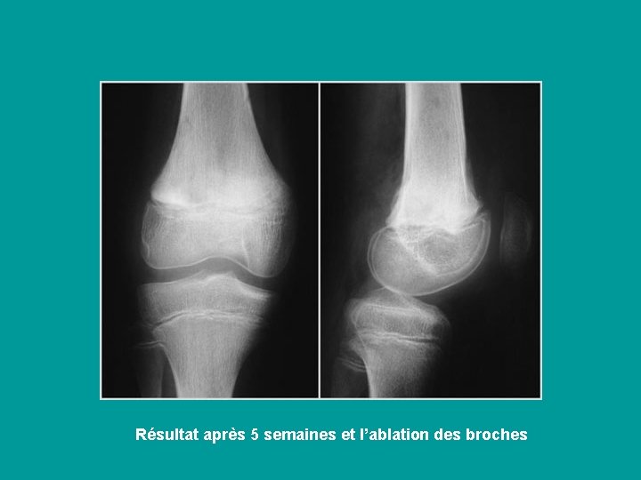 Résultat après 5 semaines et l’ablation des broches 
