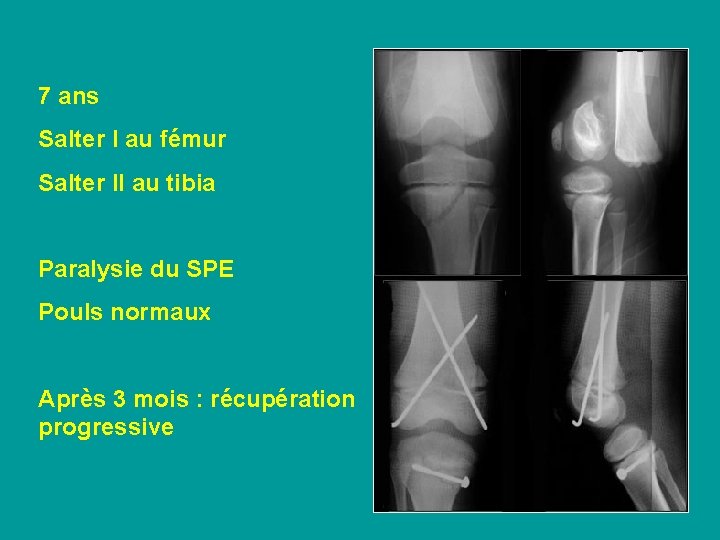 7 ans Salter I au fémur Salter II au tibia Paralysie du SPE Pouls