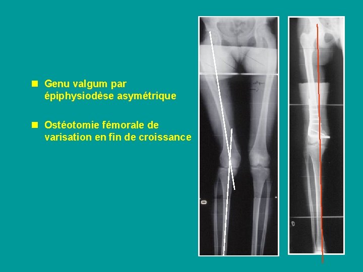 n Genu valgum par épiphysiodèse asymétrique n Ostéotomie fémorale de varisation en fin de