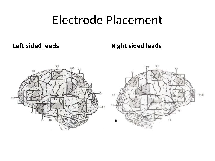 Electrode Placement Left sided leads Right sided leads 