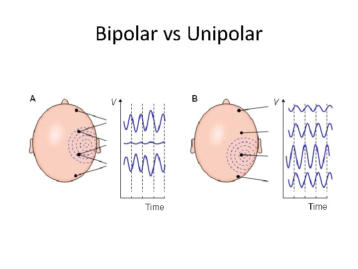 Bipolar vs Unipolar 