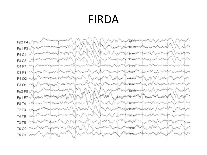 FIRDA 