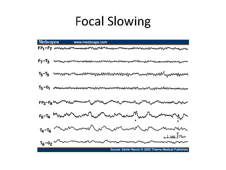 Focal Slowing 