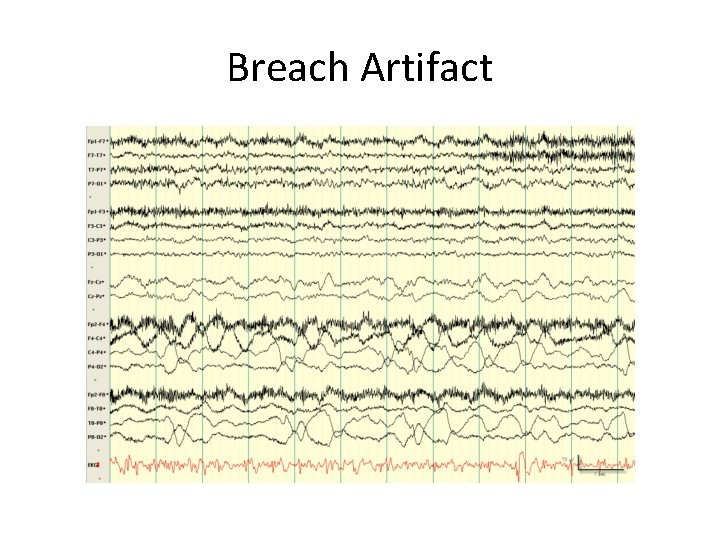 Breach Artifact 