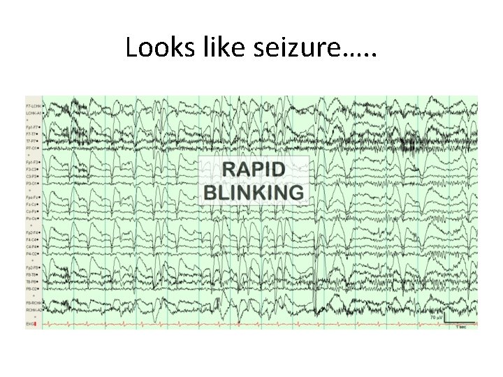 Looks like seizure…. . 