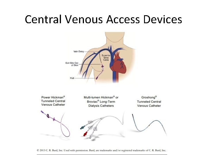 Central Venous Access Devices Groshong 