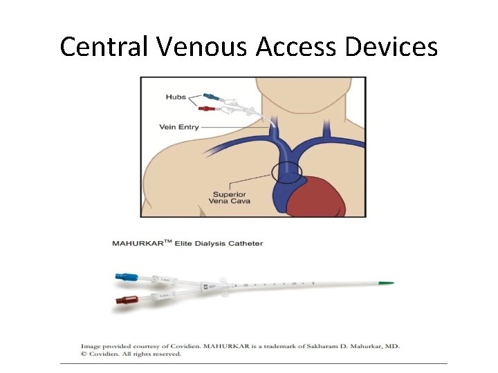 Central Venous Access Devices 