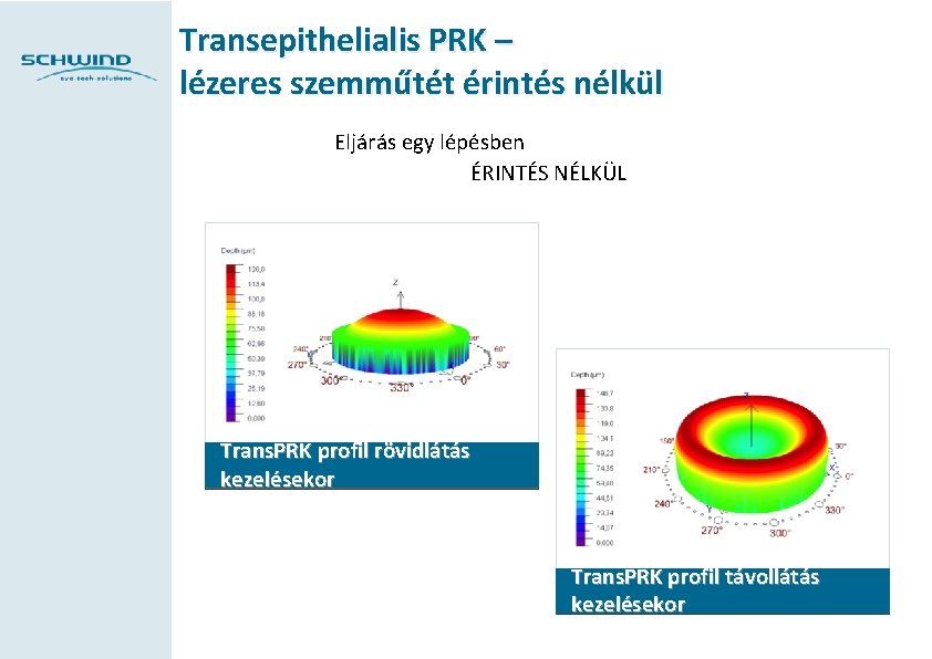 Transepithelialis PRK – lézeres szemműtét érintés nélkül Eljárás egy lépésben ÉRINTÉS NÉLKÜL Trans. PRK