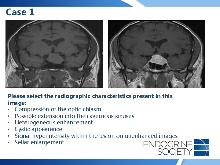 Case 1 Please select the radiographic characteristics present in this image: • Compression of