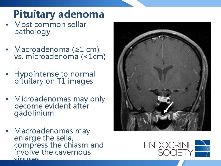 Pituitary adenoma • Most common sellar pathology • Macroadenoma (≥ 1 cm) vs. microadenoma