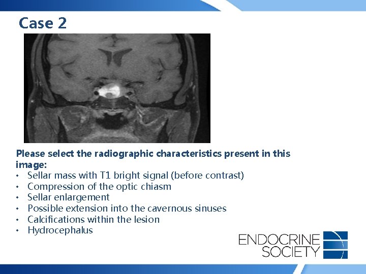 Case 2 Please select the radiographic characteristics present in this image: • Sellar mass