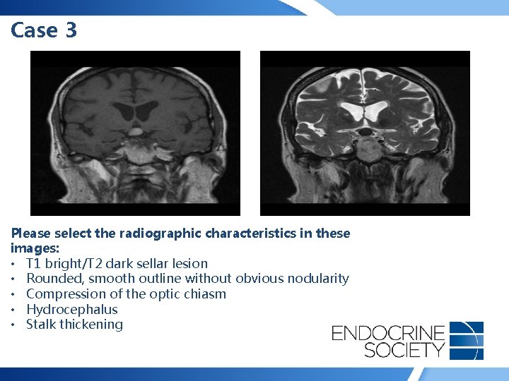 Case 3 Please select the radiographic characteristics in these images: • T 1 bright/T