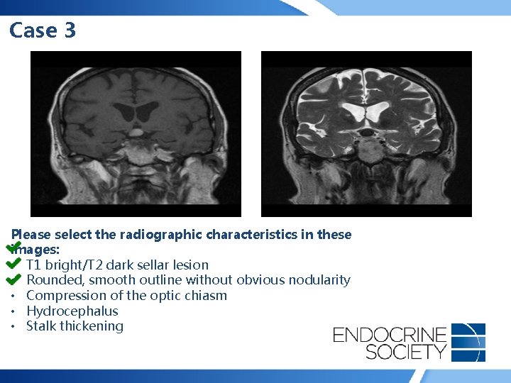Case 3 Please select the radiographic characteristics in these images: • T 1 bright/T