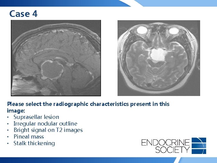 Case 4 Please select the radiographic characteristics present in this image: • Suprasellar lesion