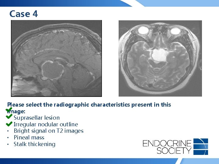 Case 4 Please select the radiographic characteristics present in this image: • Suprasellar lesion