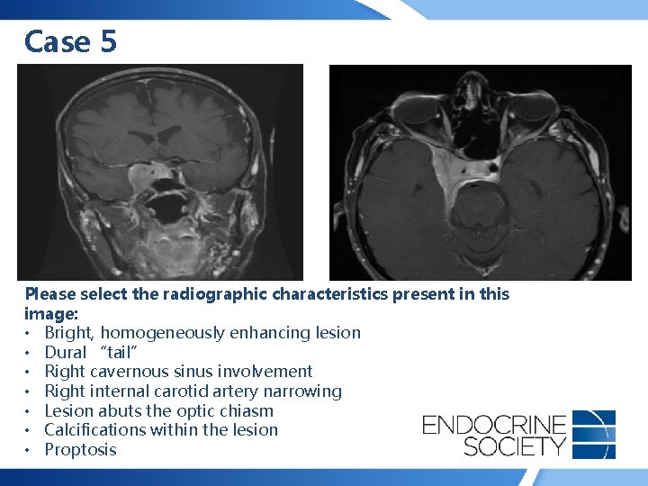 Case 5 Please select the radiographic characteristics present in this image: • Bright, homogeneously