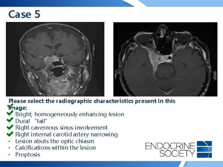 Case 5 Please select the radiographic characteristics present in this image: • Bright, homogeneously