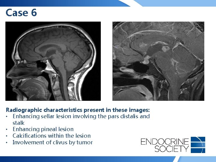 Case 6 Radiographic characteristics present in these images: • Enhancing sellar lesion involving the