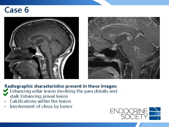 Case 6 Radiographic characteristics present in these images: • Enhancing sellar lesion involving the