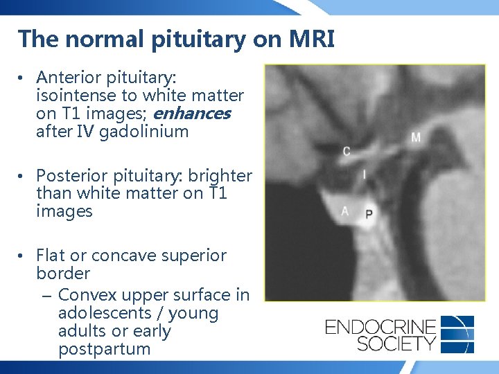 The normal pituitary on MRI • Anterior pituitary: isointense to white matter on T