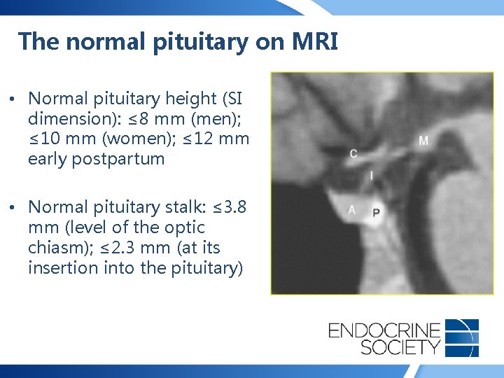 The normal pituitary on MRI • Normal pituitary height (SI dimension): ≤ 8 mm