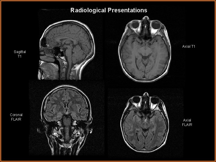 Radiological Presentations Axial T 1 Sagittal T 1 Coronal FLAIR Axial FLAIR 