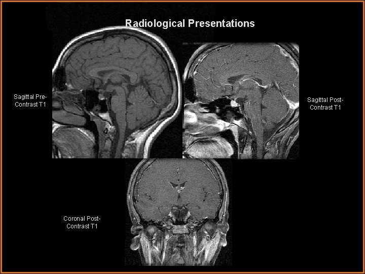 Radiological Presentations Sagittal Pre. Contrast T 1 Sagittal Post. Contrast T 1 Coronal Post.