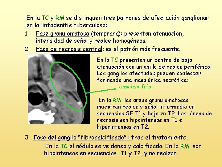 En la TC y RM se distinguen tres patrones de afectación ganglionar en la