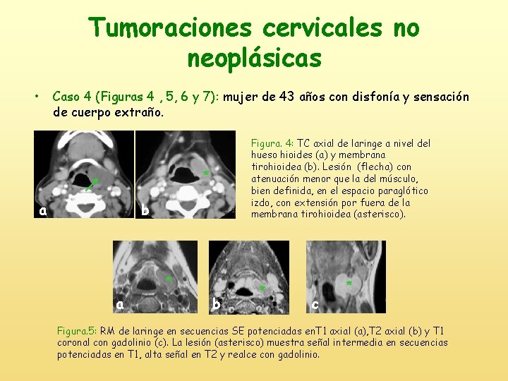 Tumoraciones cervicales no neoplásicas • Caso 4 (Figuras 4 , 5, 6 y 7):