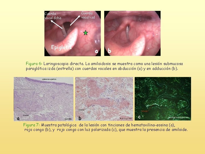 Cuerda vocal izd Cuerda vocal dcha * Epiglotis a b Figura 6: Laringoscopia directa.